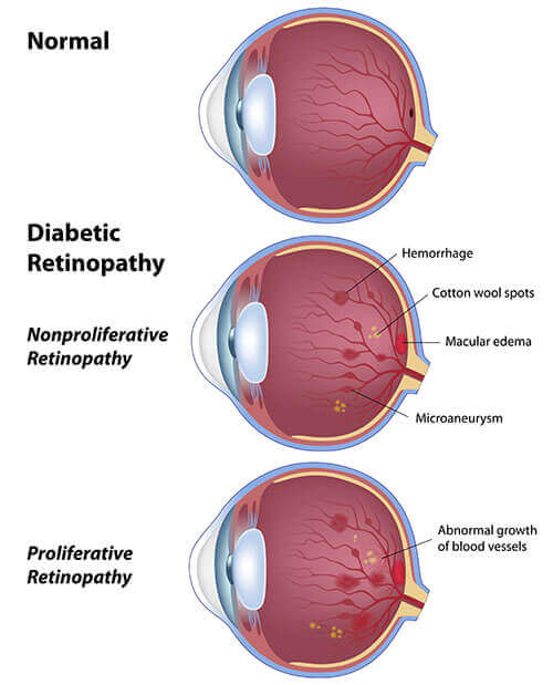 Chart Illustrating a Normal Eye vs One With Diabetic Retinopathy